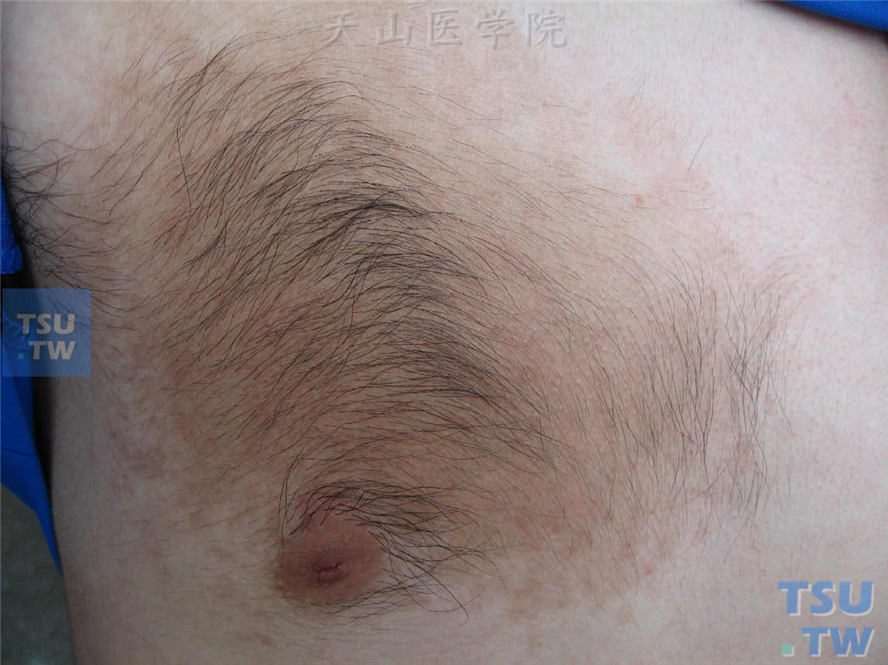 淡褐色斑状损害，表面可见增粗毛发