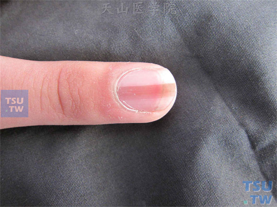 甲母痣nevusofthenailmatrix症状表现