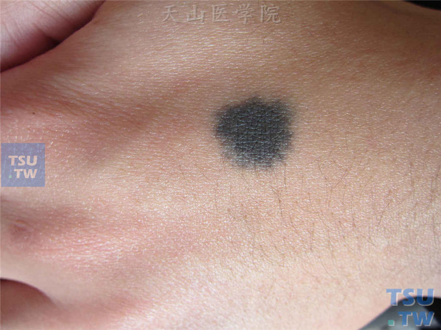 蓝痣（blue nevus）症状表现