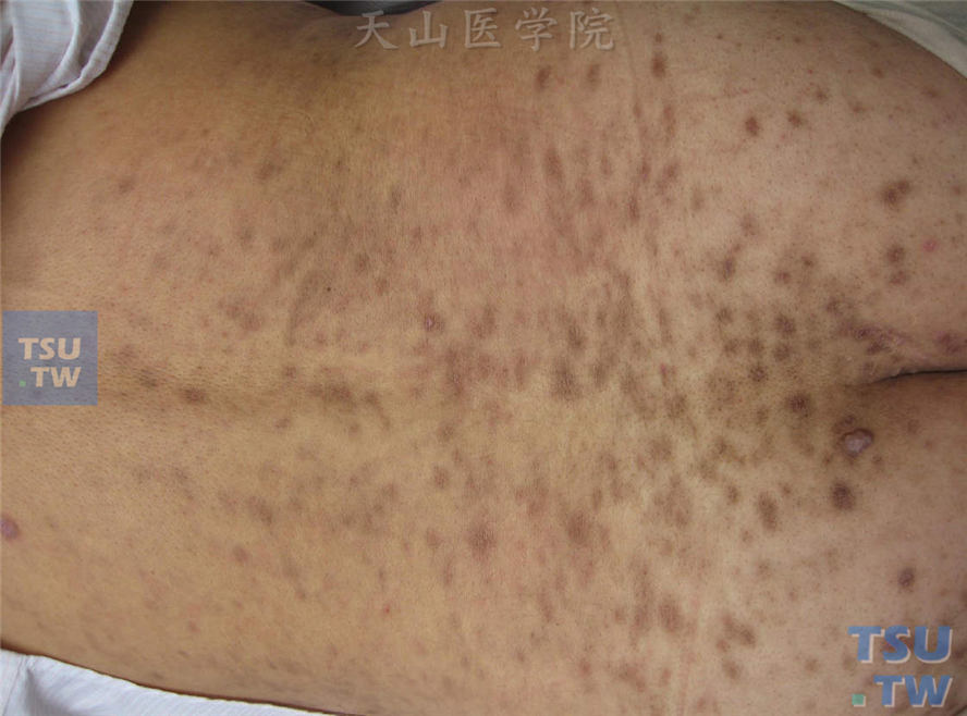 色素性玫瑰糠疹（roseola pigmentosa）症状表现