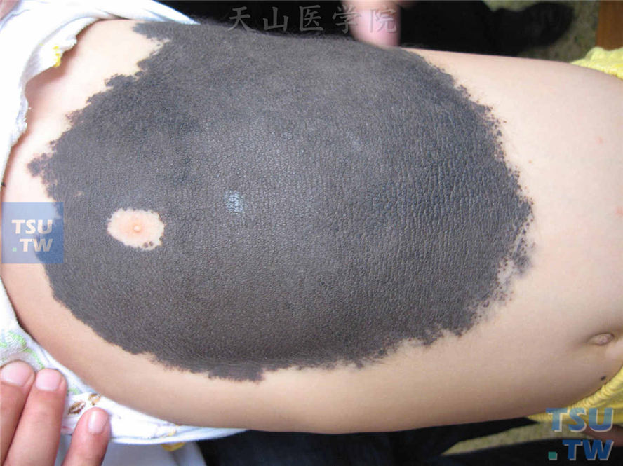 先天性色痣（congenital pigmented nevus）症状表现