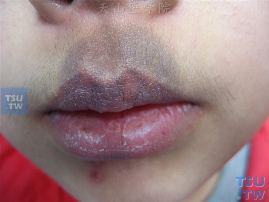 固定型药疹.口唇部位遗留的色素沉着斑