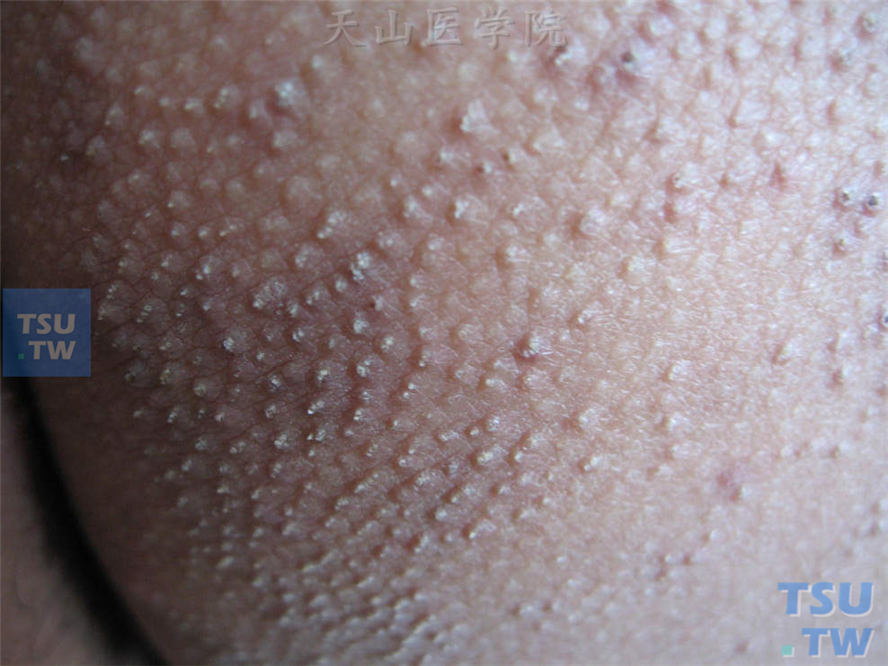 毛囊性角化性丘疹，触之较硬，中央可见棘刺状角质栓