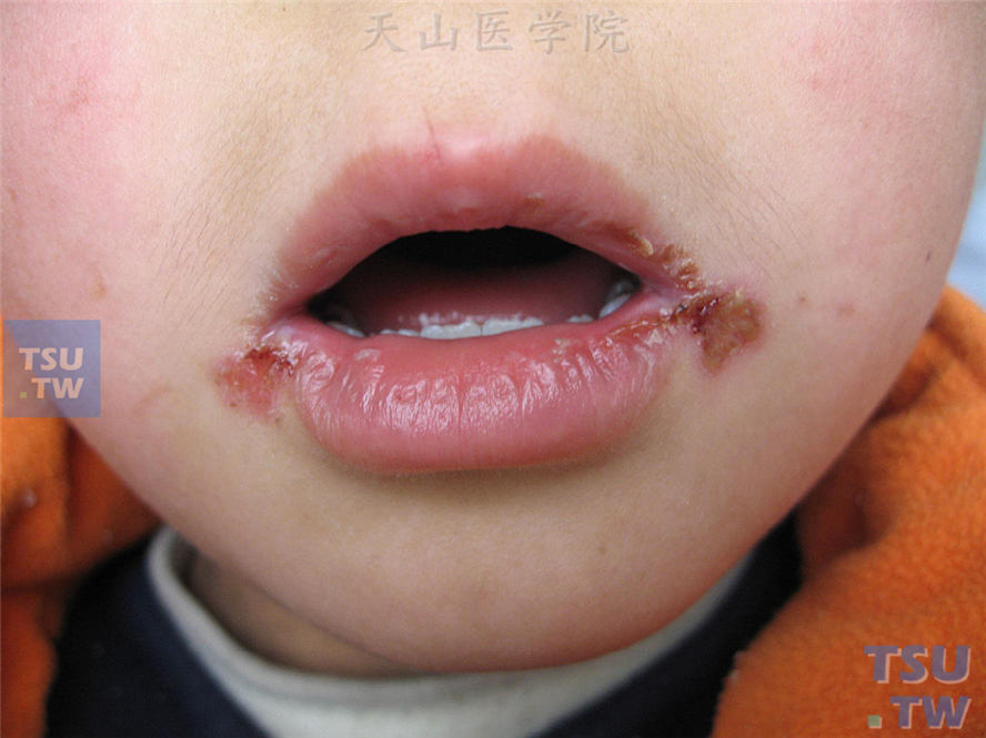 肠病性肢端皮炎：同一患儿口角糜烂、结痂