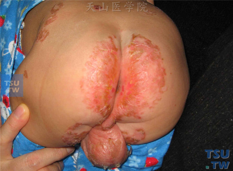 肠病性肢端皮炎：同一患儿，肛周、阴囊、腰部红斑、糜烂、脱屑