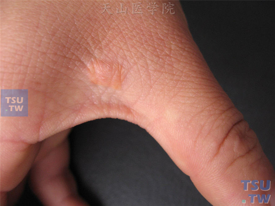 间擦性黄瘤：指间稍高起的黄色斑块