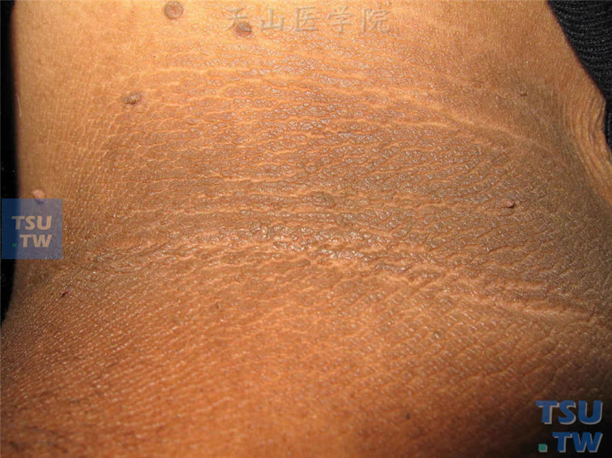 黑棘皮病（acanthosis nigricans）症状表现