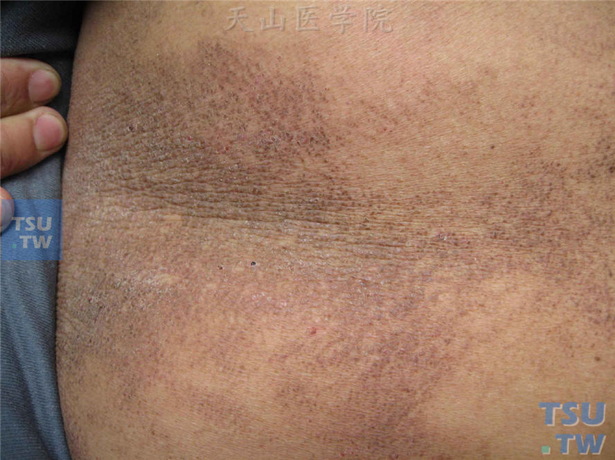 斑状淀粉样变：背部点状黑褐色斑疹聚合成网状