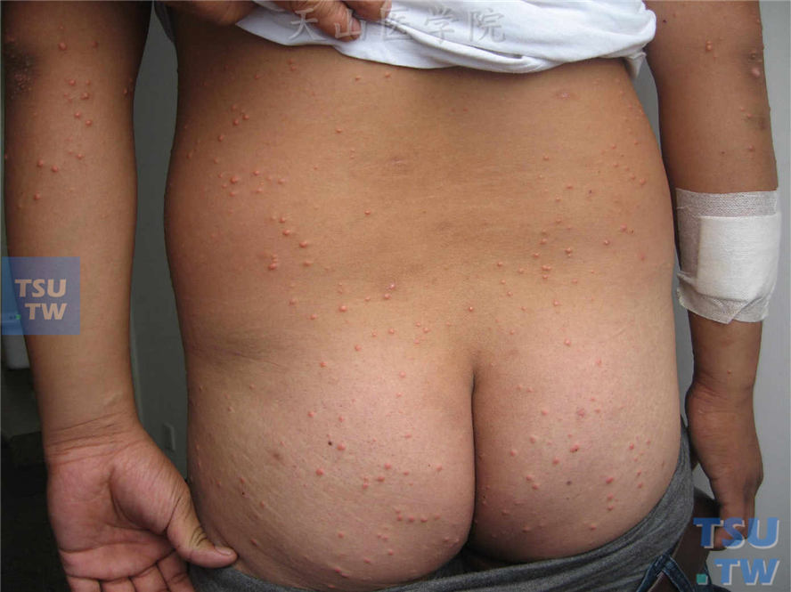 皮损表现为发疹性黄瘤的表现