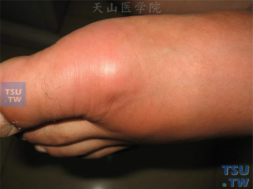 痛风（gout、一种晶体性关节炎）的症状表现