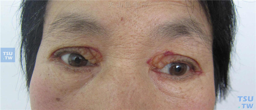 眼睑周围瘀点、瘀斑、黄色结节，表现形似黄瘤。