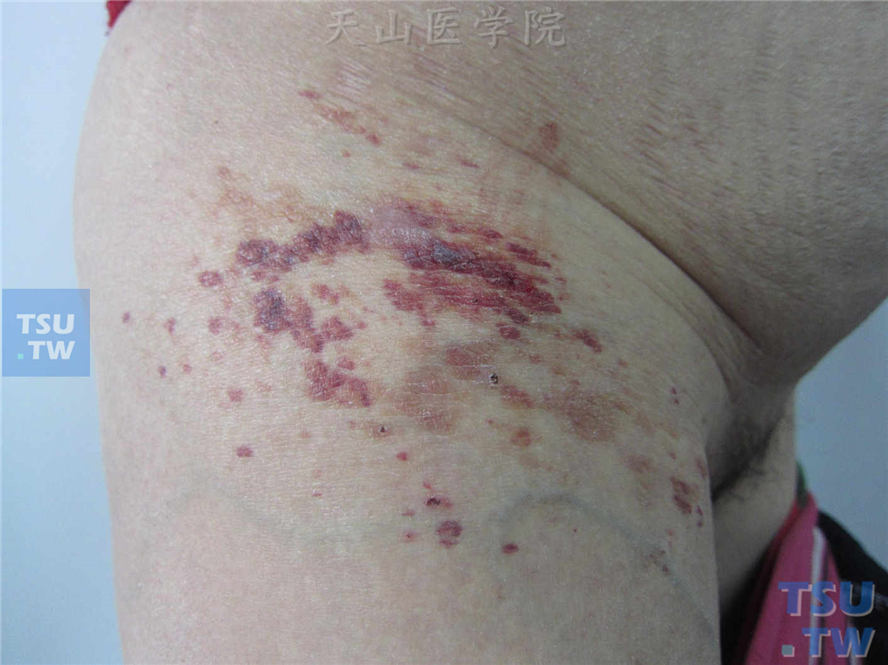 同一病人右侧大腿根部表现