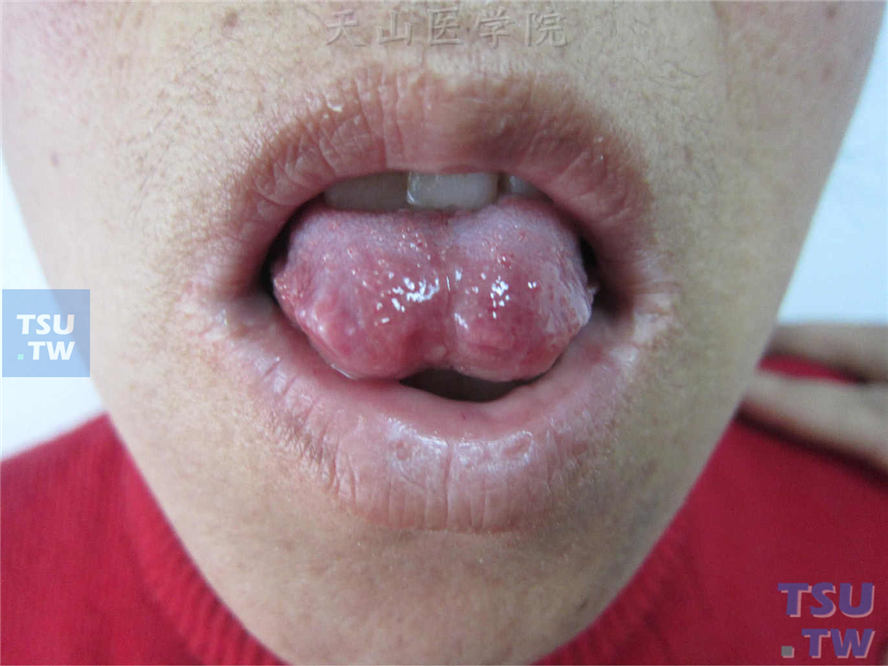 同一病人舌部可见明显齿痕，针尖大小瘀点