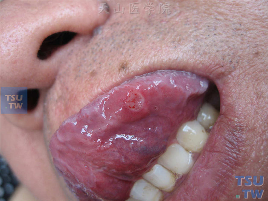 舌头溃疡舌尖图片