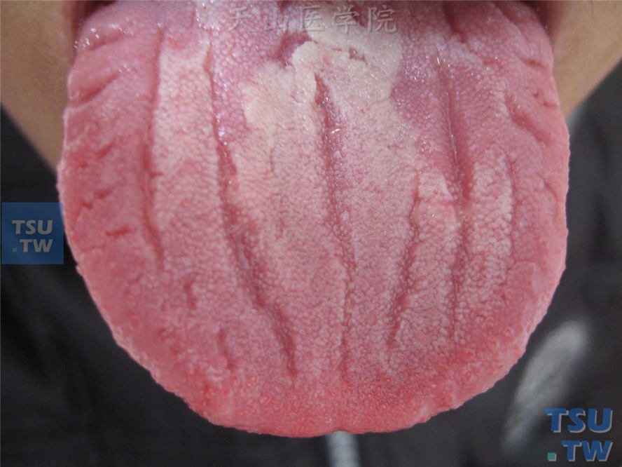 舌面脑回状沟纹
