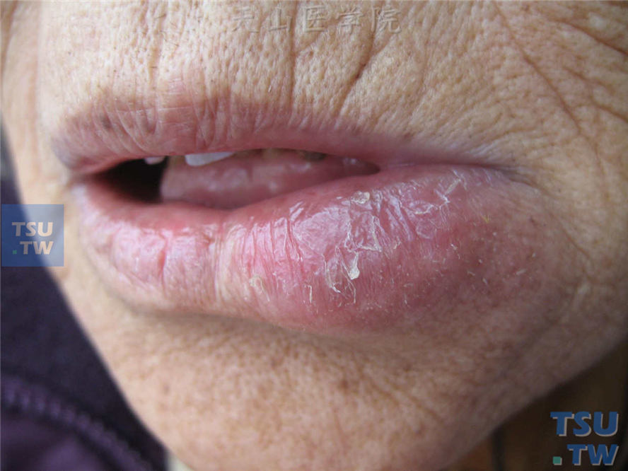 肉芽肿性唇炎（cheilitis granulomatosa）症状表现