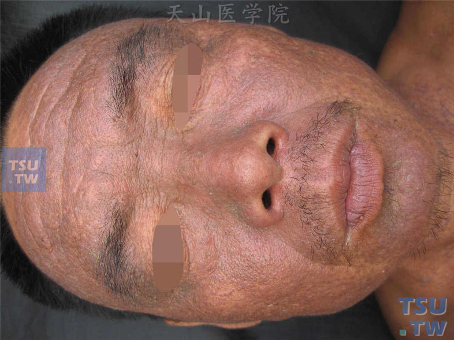 面部密集灰褐色角化性丘疹，部分似扁平疣样损害，鼻部损害融合，表面被覆油脂样污痂