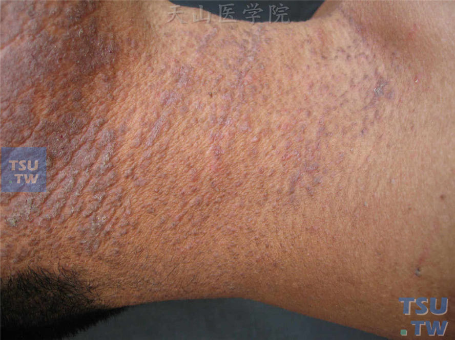 同一病人，颈部角化性丘疹，表面增殖性损害，沿皮纹排列呈线状