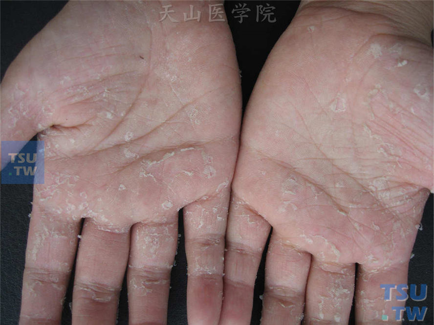 剥脱性角质松解症（keratolysis exfoliativa）症状表现