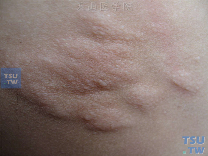 结缔组织痣（connective tissue nevus）症状表现