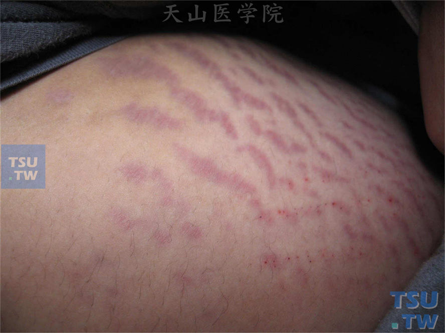 萎缩纹（striae atrophicae）症状表现