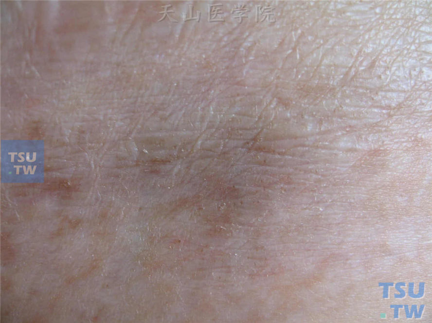 图下部明显凹陷，正常皮沟变少、变浅或消失，显示表皮、真皮及皮下组织同时萎缩