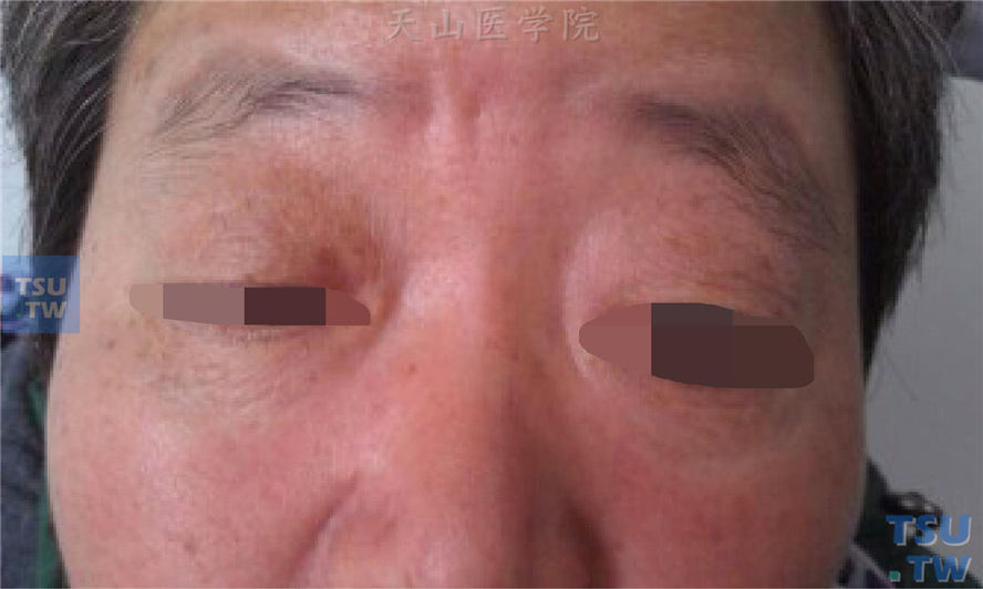 上睑下垂（ptosis）症状表现