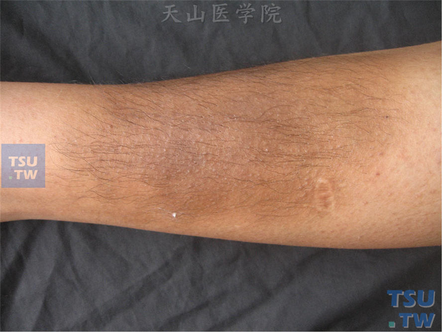 外伤性脂膜炎（traumatic panniculitis）症状表现