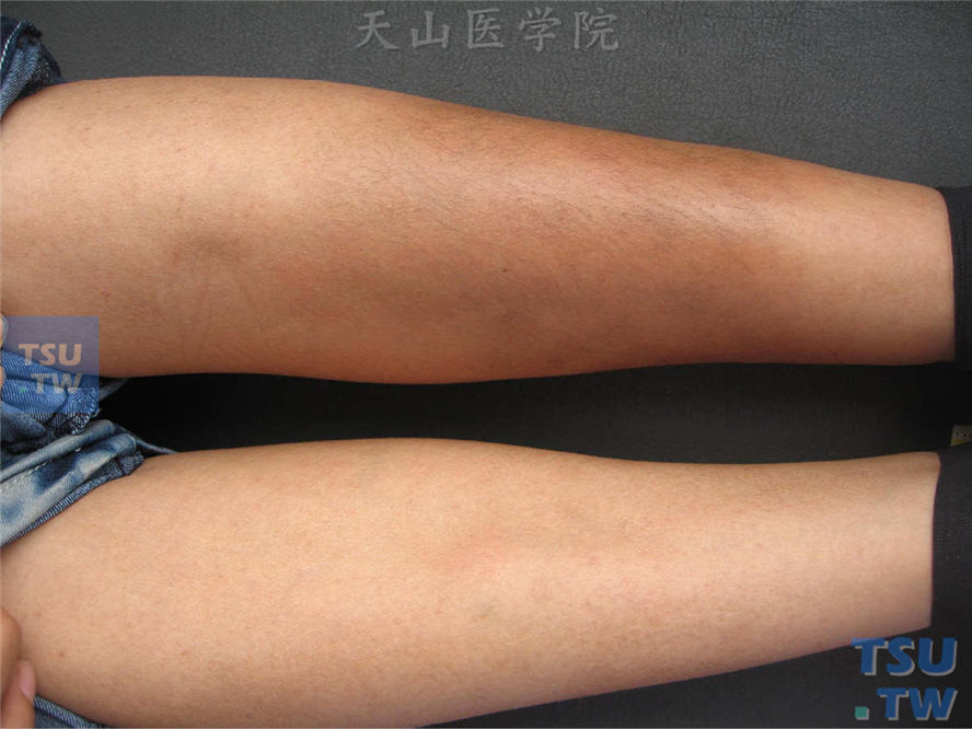 硬化性脂膜炎（sclerosing panniculitis）症状表现