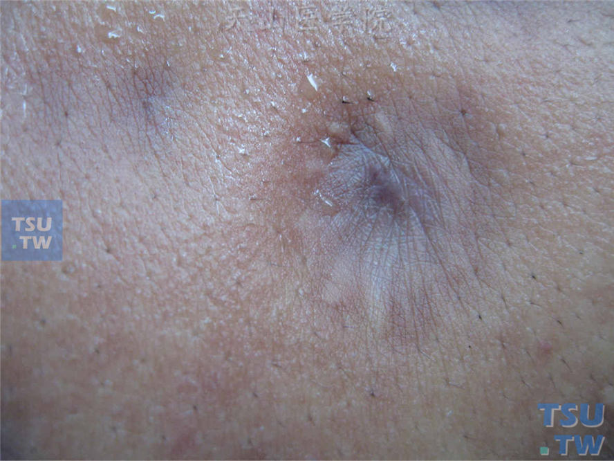 局限性特发性脂肪萎缩：局部皮肤凹陷，表皮纹理基本正常