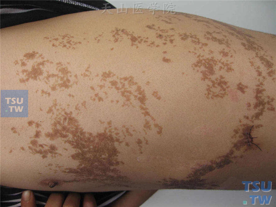 躯干涡纹状排列褐色斑疹、角化性丘疹