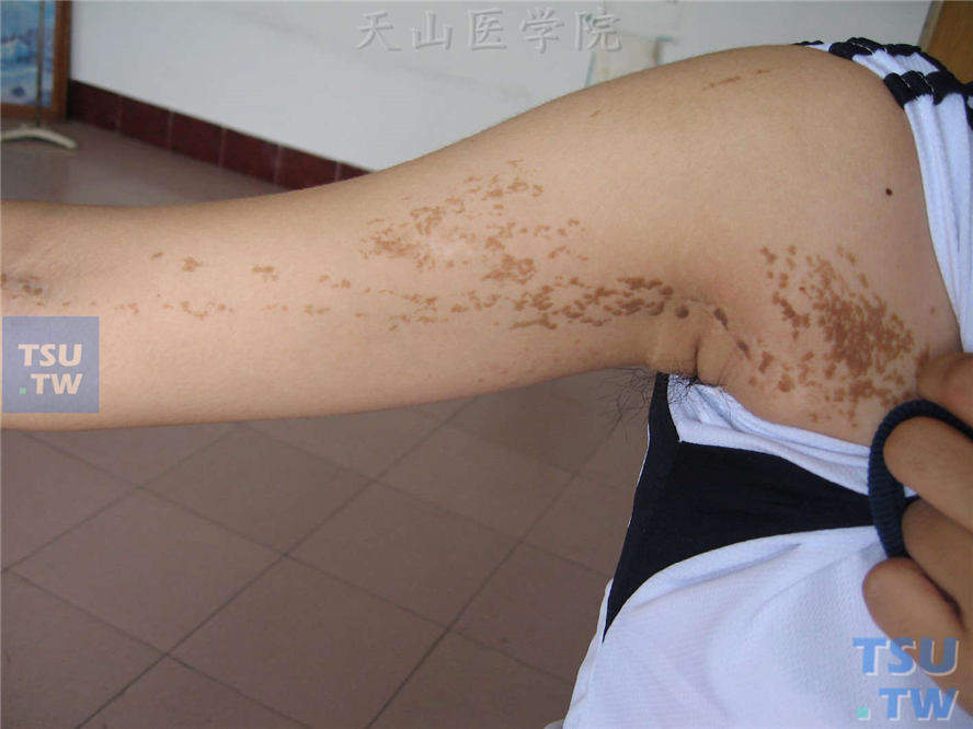 线状表皮痣：皮损为密集的淡褐色至褐色丘疹，沿肢体一侧排列呈线形