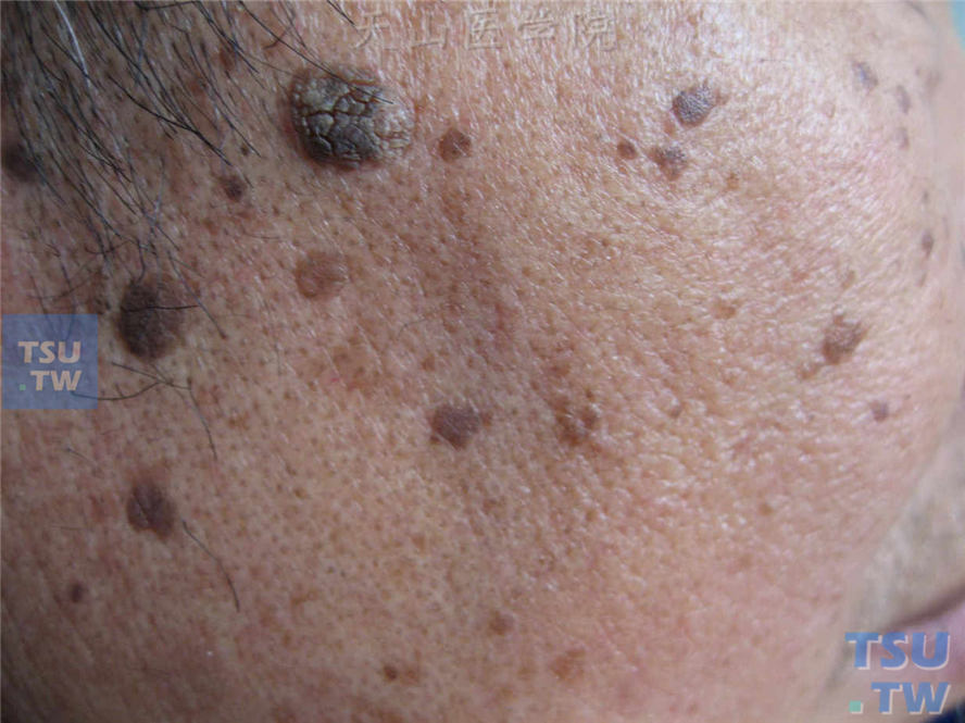 面部多发大小不等淡褐色、褐黑色扁平斑丘疹、丘疹，部分表面疣状增生