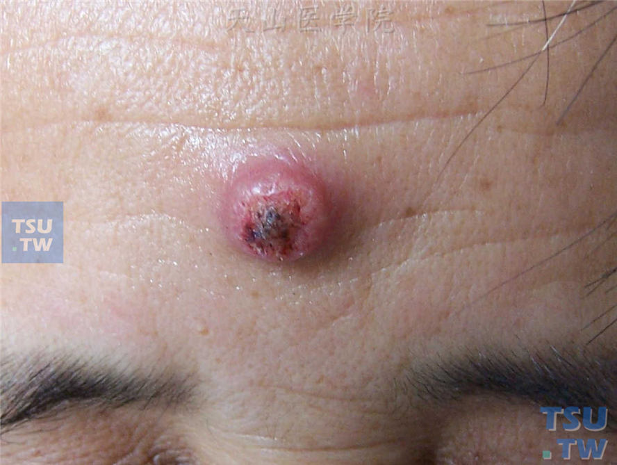 前额淡红色黄豆大小坚实圆顶丘疹，表面光滑，中央充满角质
