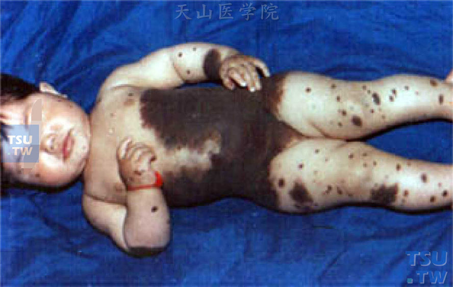 患儿躯干、四肢可见大片深褐色斑块，表面粗糙，呈疣状
