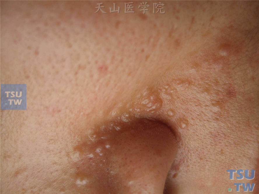 毛发上皮瘤：鼻唇沟处粟粒至米粒大小肤色质硬丘疹，有透明感