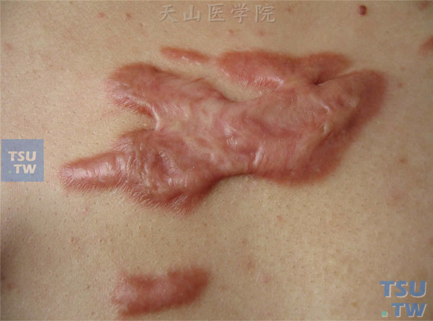 良性肿瘤：瘢痕疙瘩（keloid）症状表现