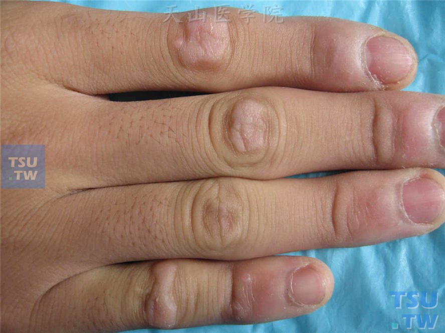 指关节伸侧正常皮色扁平隆起角化性损害