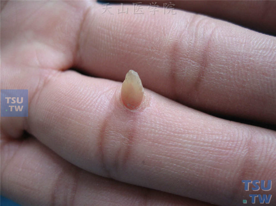 指关节屈侧手指状肿物，质硬，表面可见角质增生