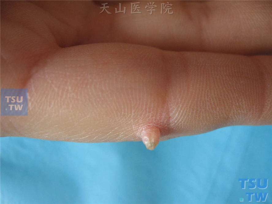 手指侧缘手指状肿物，表面中央角质增生