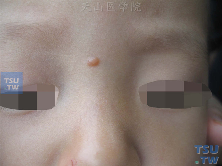 幼年性黄色肉芽肿：鼻根部黄豆大小丘疹，表面光滑，黄红色