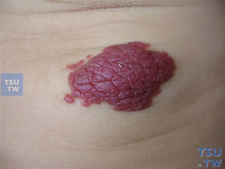 草莓状血管瘤（strawberry hemangioma）：紫红色分叶状肿瘤，高出皮面，质地柔软，边界清楚