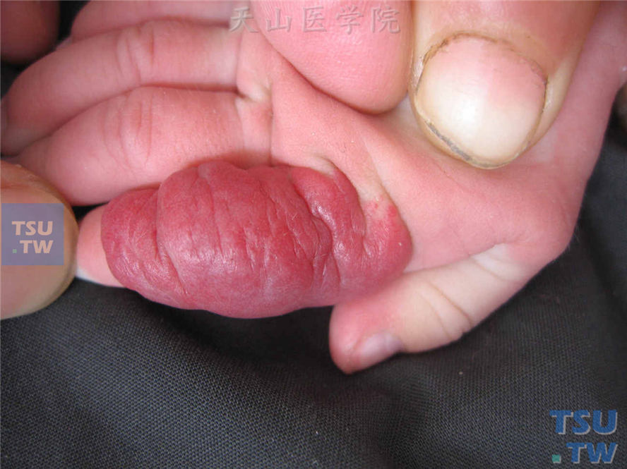 手指草莓状血管瘤