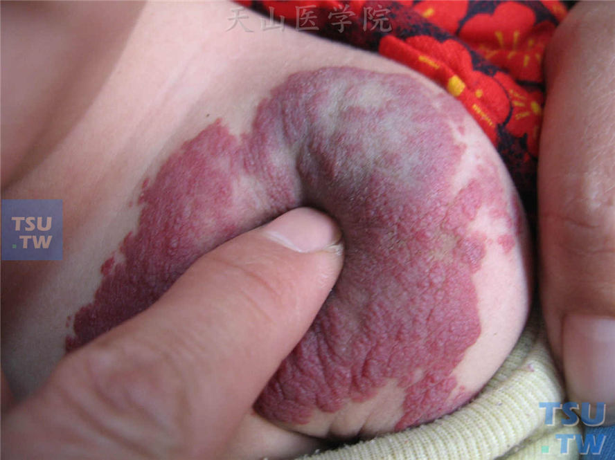 海绵状血管瘤又称静脉畸形：臀部肿物，表面鲜红色分叶状，深部紫蓝色，边界不清，柔软而有弹性，压之状似海绵