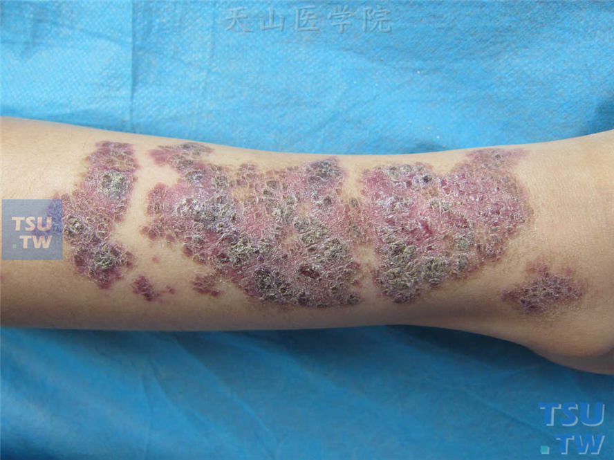 前臂密集紫红色角化性丘疹，部分融合成片状