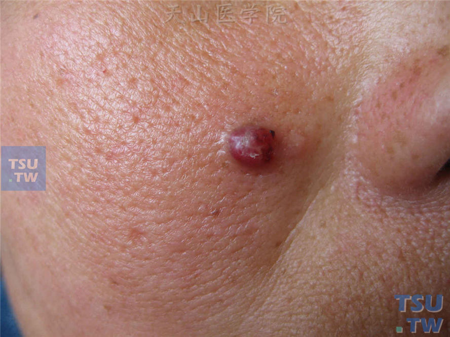 化脓性肉芽肿（pyogenic granuloma），面颊黄豆大小鲜紫红色丘疹，表面光滑，触之柔软，易出血