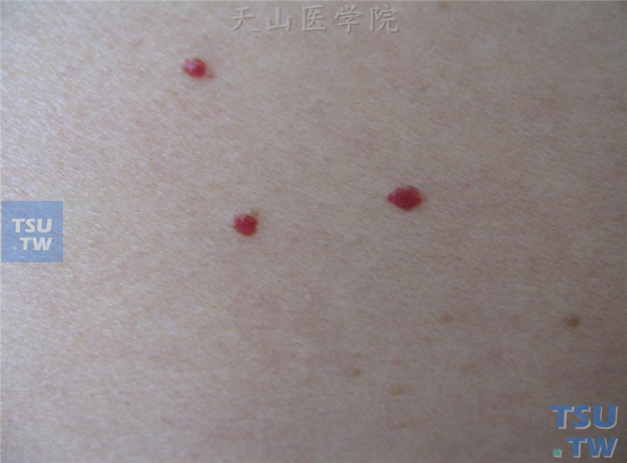 良性肿瘤：老年性血管瘤（senile angioma）症状表现