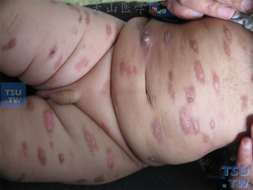 幼儿胸腹部、双大腿大小不一卵圆形色素性斑疹