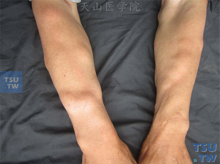 脂肪瘤：该病人双上肢见多处柔软、分叶状皮下肿物，可移动，对称分布，表面皮肤正常