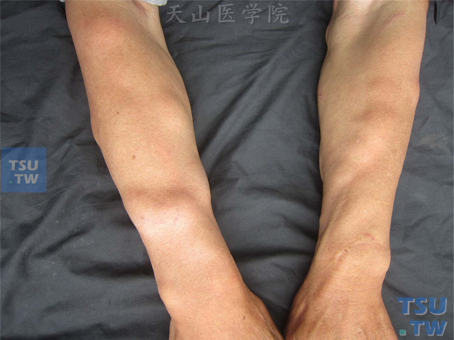 良性肿瘤：脂肪瘤（lipoma）症状表现